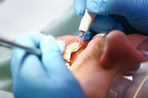 Best Emergency Tooth Extraction in New Haven, CT